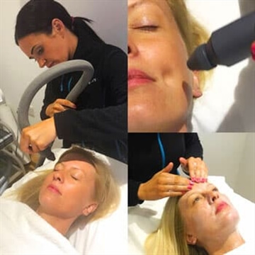 Cryotherapy Facial in Kent